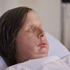 Chimp Mauling Victim's Face Transplant Revealed